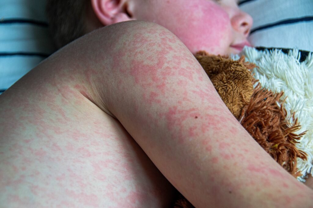 US Measles Outbreak Keeps Growing